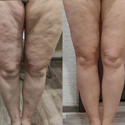 UltraSlim™- Ultrasonic Fat & Cellulite Burner