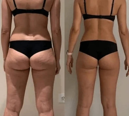 UltraSlim™- Ultrasonic Fat & Cellulite Burner